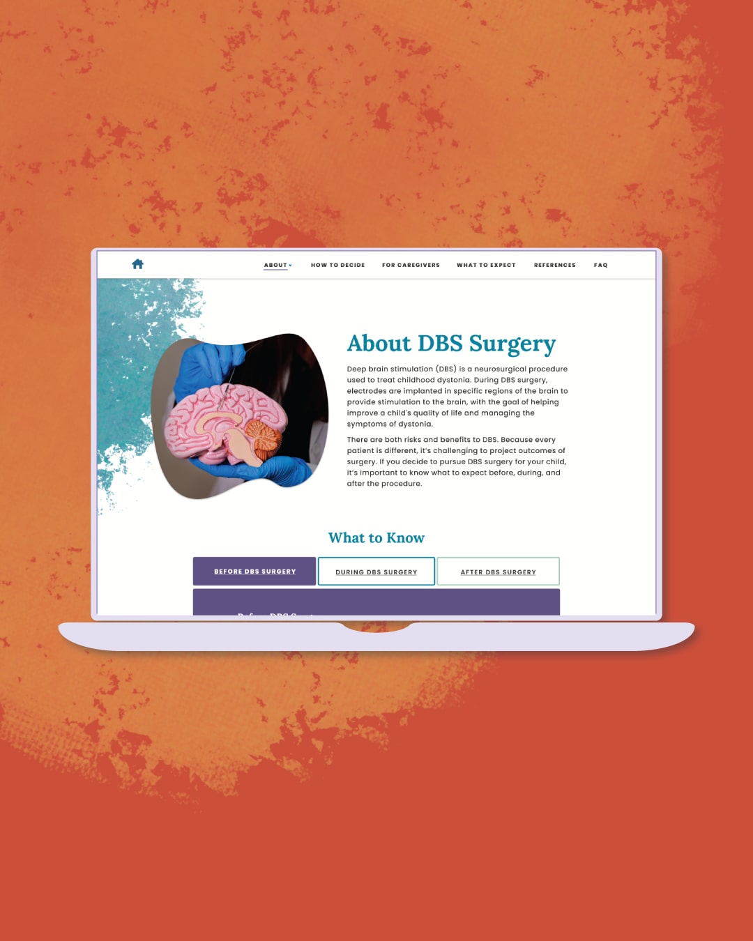 DBS Decision Aid About DBS Surgery on laptop.