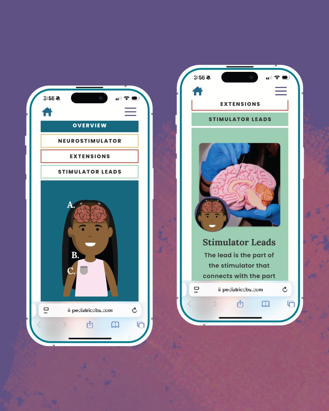 DBS Decision Aid About DBS Treatment on mobile.